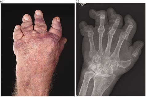 Radiographic Scoring Systems For Psoriatic Arthritis Are Insufficient For Psoriatic Arthritis