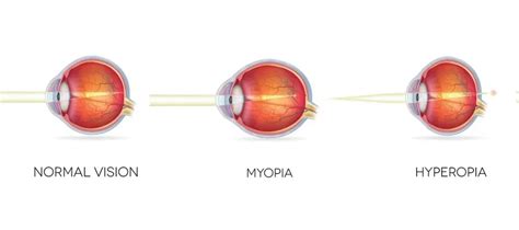 LASIK for Farsightedness (Hyperopia) in Kansas City | Discover Vision