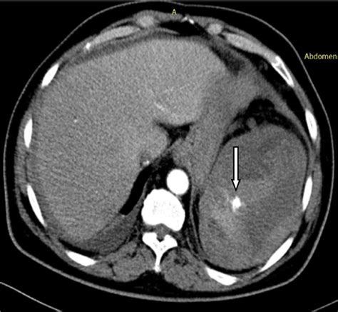 Cect In Delayed Arterial Phase Showing Contrast Blush In Traumatic