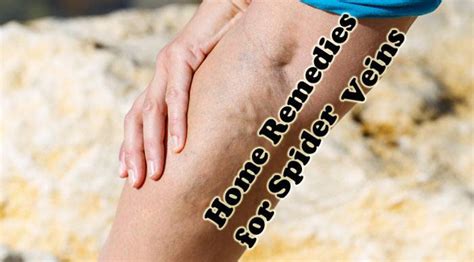 Home Remedies for Spider Veins - Healthy Focus