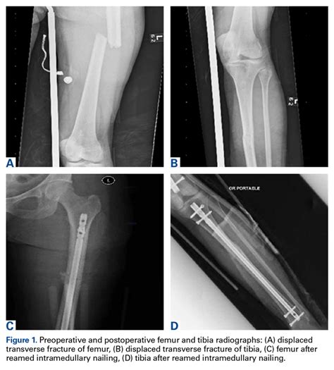 Fat Embolism Syndrome With Cerebral Fat Embolism Associated With Long