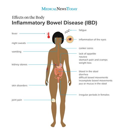 Inflammatory Bowel Disease Causes Symptoms And Treatments In