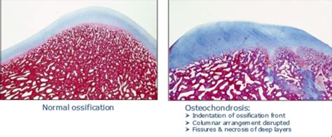 Developmental Diseases Of Msk System Flashcards Quizlet