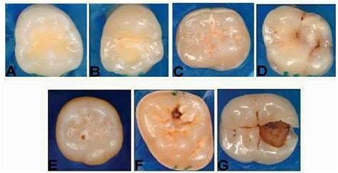 Tejidos Dentales ClasificaciÓn De La Caries