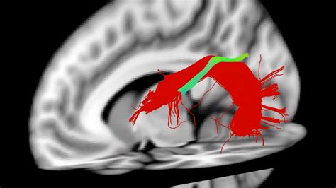 Animated 3d Model Of Arcuate Fasciculus Segments Youtube