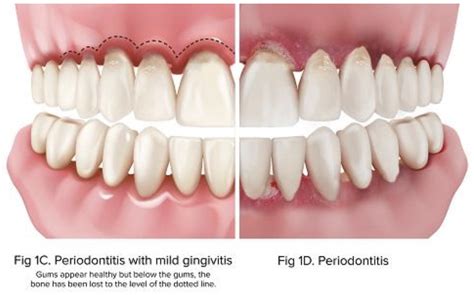 Periodontology Dental Clinic Dentince