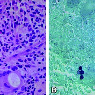 Figure. Patient with blastomycosis, India, 2014. A) Photograph of chest ...