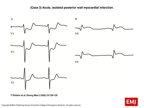 Case Acute Isolated Posterior Wall Myocardial Infarction Ppt