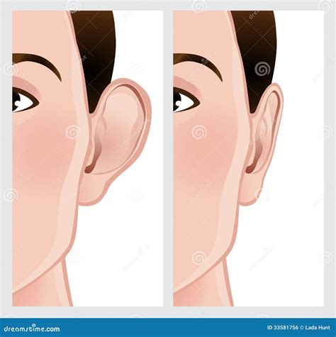 Ear Pinning Otoplasty Stock Illustration Illustration Of Pinning