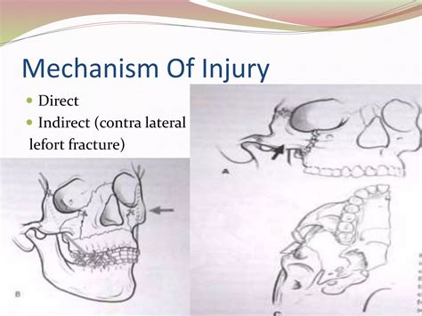 Management Of Zygomatic Complex Fractures Ppt