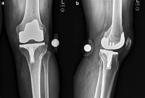 Revision Total Knee Arthroplasty Using Robotic Arm Technology