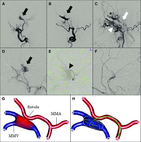 Dsa And Schema Of Mmavf A Anteroposterior And B C Lateral Views