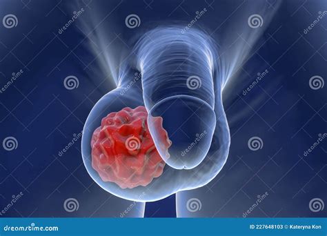 Testicular Cancer 3d Illustration Stock Illustration Illustration Of