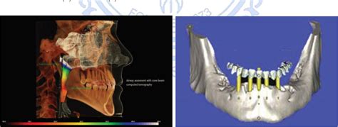 Figure 4 From Application Of Cone Beam Computerized Tomography In