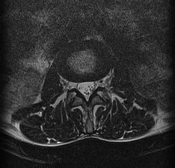 Spinal Schwannoma Image Radiopaedia Org