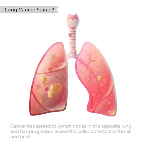 Vector Illustration Of Lung Cancer Stock Vector Illustration Of Body