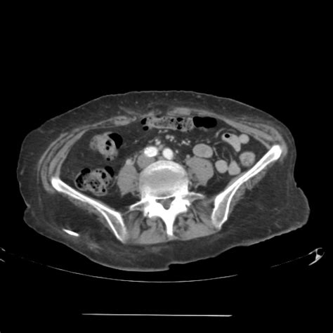 Pyeloureteral Transitional Cell Carcinoma Image