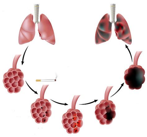 Enfisema Pulmonar Brasil Escola