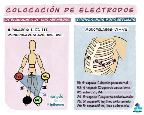 ¿dónde Coloco Los Electrodos On Enfermería