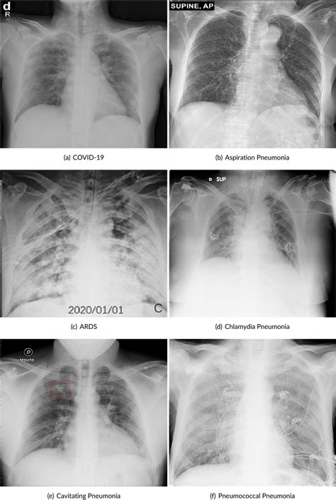 Forth sample set of COVID‐19 and various pneumonia disease affected... | Download Scientific Diagram