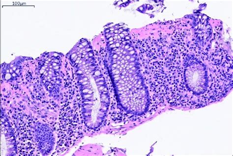 Random Colon Biopsy Showing Colonic Mucosa With Underlying Collagen Download Scientific Diagram