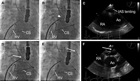 Complication Prevention In Ablation Procedures How To Perform