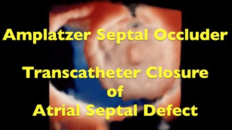 Amplatzer Atrial Septal Occluder: Transcathter Closure Of A large Atrial Septal Defect - Echovision