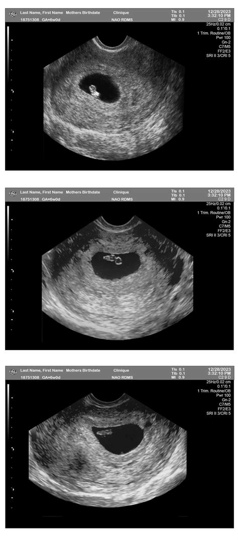 6 Week Pregnancy Scan 3 Fetuses Ultrasounds