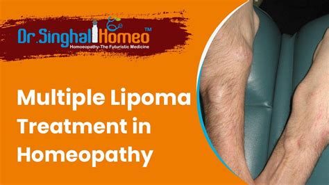 Multiple Lipoma Treatment In Homeopathy