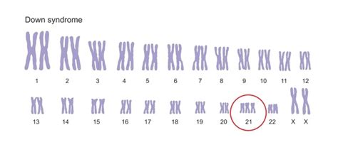 Hundred Chromosomal Anomaly Royalty Free Images Stock Photos