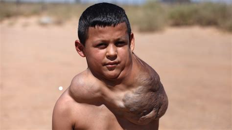 Ten Year Old Has Giant Neck Tumour Body Bizarre Episode 1 YouTube