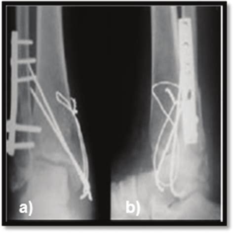 Postoperative X Ray Of Right Ankles Anteroposterior A And Lateral