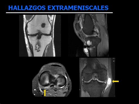 Seguimiento Mediante Rm De Suturas Meniscales Con Correlacin