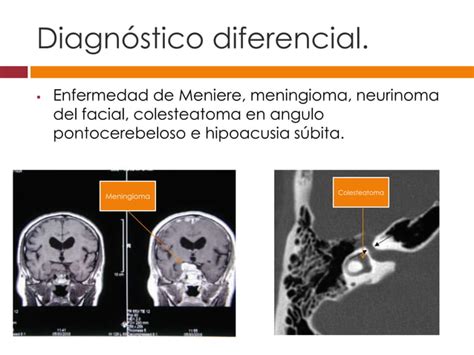 Neurinoma del acústico o schawnnoma vestibular 2013 PPT