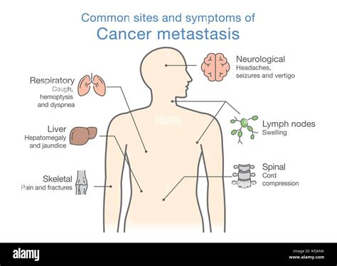 Most Common Sites And Symptoms Of Cancer Metastasis Stock Vector Image