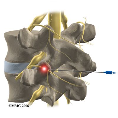 Medial Branch Block | California Spine Care | Dr. Santi Rao