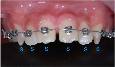 Class Ii Malocclusion With Severe Overjet Treated With Maxillary Second