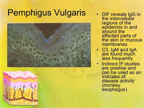 Pemphigus vulgaris