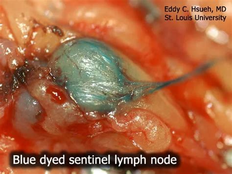 Melanoma Sentinel Lymph Node Biopsy