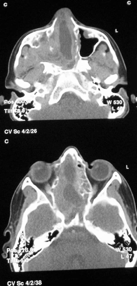 Sagital Plane Ct Slices Revealing The Extension Of A Right Maxillary