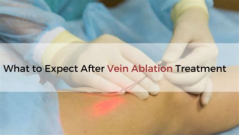 What To Expect After Vein Ablation Treatment