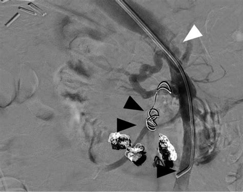 Postintervention Venogram From The Superior Mesenteric Vein