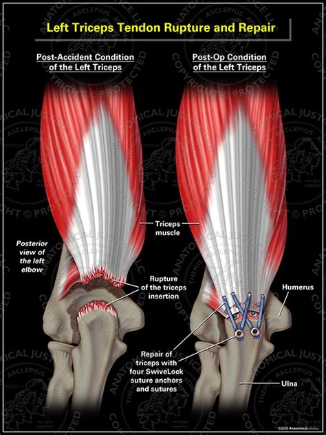 Left Triceps Tendon Rupture And Repair