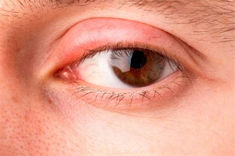 Chalazion qué Es Como Se Trata Y Diferencias Con El Orzuelo