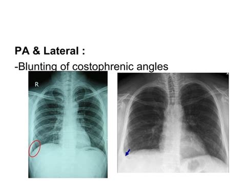 Pleural Lesions Ppt