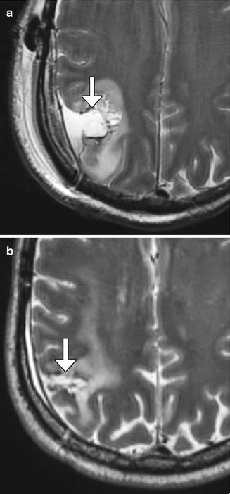 Imaging The Intraoperative And Postoperative Brain Radiology Key