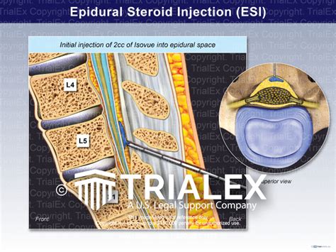 Epidural Steroid Injection (ESI) - TrialExhibits Inc.