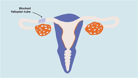 How uterine anomalies impact fertility