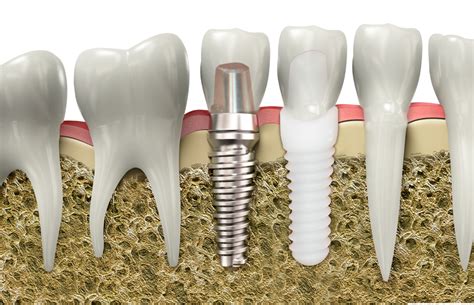 Zirconia Dental Implants | Boston Dental Wellness