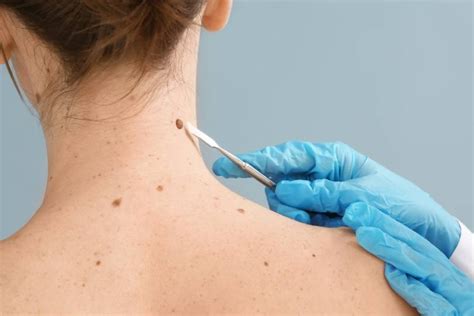 Mole Removal Treatment In Baner Mole Removal The 101 Clinic